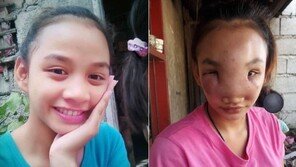 여드름인 줄 알고 짰는데…혹으로 얼굴 뒤덮인 필리핀 소녀