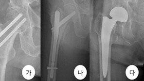 겨울철 노인 건강 위협하는 ‘고관절 골절’