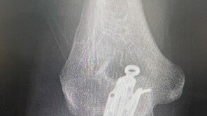 개코, 팔 골절 수술 후 근황…“엑스레이 찍었는데 거의 다 붙어”