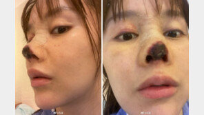 “코만 빼면 완벽” 말에 성형했다가…코끝 괴사한 中여배우