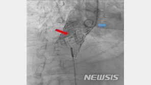 가슴 열지 않고 정맥 활용…병든 심장 판막 첫 교체