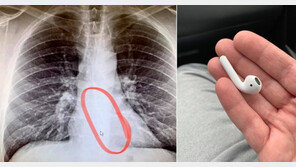 귀에 꽂고 자다 사라진 이어폰이 뱃속에…“물이 안넘어가”