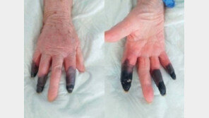 “감염 몰랐다가…” 코로나 후유증으로 손가락 괴사→절단