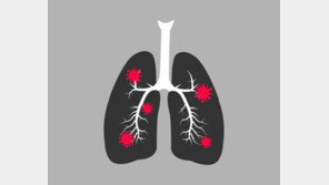 코로나 감염자 폐 이식받고 사망…미국 내 첫 사례