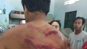 등에 시뻘건 피멍 자국이…“미얀마 군경, 체포 후 고문” 증언