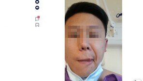 시노백 백신 맞은 홍콩 26세 안면 마비…의료진 “몇달 갈 수도”