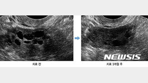 다낭난소증후군, 비만무관…당뇨위험 두 배 이상 높다