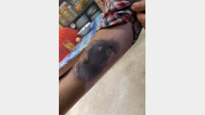 “미얀마 군부, ‘아웅산 수지 문신’ 새긴 시민 팔을 불로 지졌다”