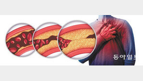 이상지질혈증 치료제 ‘피타바스타틴’, 당뇨병 안전성 입증