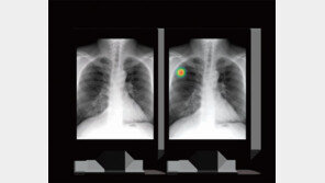 [DBR/Case Study:]70%대인 엑스레이 폐암 진단율, 97%까지 높여