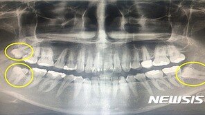 제2의 어금니 ‘사랑니’…잘못 뽑으면 합병증 유발