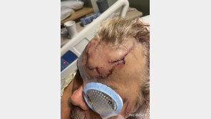 10초만에 부서진 얼굴뼈…불곰 만나 구사일생한 남성