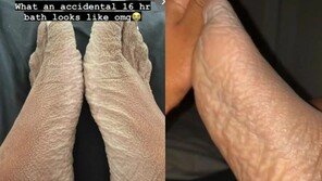 욕조서 16시간 잠들었다가 그만…끔찍한 ‘발’에 충격