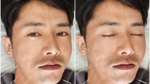 오종혁, 얼굴에만 침 십수 개…구안와사 투병 중