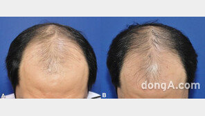 탈모 치료 넘보는 ‘대웅제약 나보타’·… 최신 치료 사례·시술법 공유