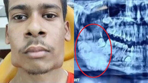 ‘사각턱’인 줄 알았는데…X레이 찍어보니 ‘치아 82개’