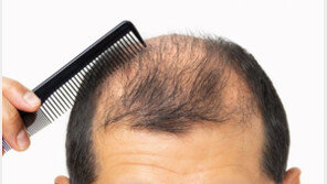 탈모증, 30대가 가장 많았다…건보공단이 조언한 예방법은?