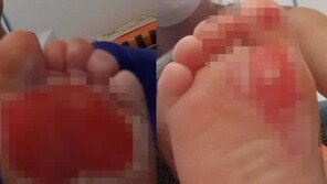 英 살인 폭염…달궈진 집 바닥에 22개월 아기 발바닥 화상