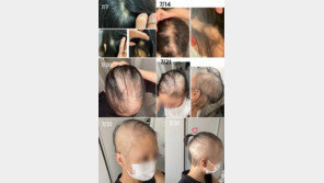 백신 접종 부작용?…日 여성 1달 만에 완전 탈모