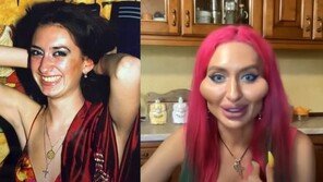 “광대뼈에 골프공?”…얼굴 필러 2년간 셀프 시술한 모델 ‘깜짝’