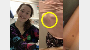 몸에 갑자기 생긴 ‘점’ 무시했다가…美 20대 말기암 판정