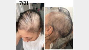 “모더나 맞고 대머리됐다” 日여성, 2차도 접종했다…왜?