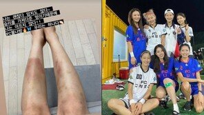 안혜경, 멍투성이 다리 공개 “나는 아무렇지도 않다”