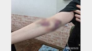 부천 30대 여성 AZ-화이자 교차접종 후 팔에 ‘피멍’