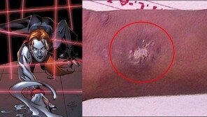 ‘마블 히어로’가 되고 싶어…몸에 수은 주입한 美 소년