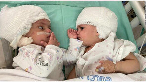 머리 붙어 태어난 이스라엘 쌍둥이 자매, 1년 만에 마주 보다
