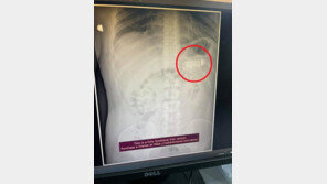 20년 된 휴대전화 삼킨 유럽 남성…2시간 수술 끝에 꺼냈다