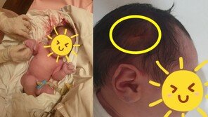 “갓 태어난 딸 머리에 칼자국” 억장 무너진 제왕절개 엄마