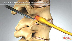 복잡하게 얽힌 ‘허리 속 터미널’ 추간공… 추간공확장술로 통증 줄인다