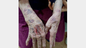 “42kg 할머니, 보호센터서 집단폭행…갈비뼈 골절”