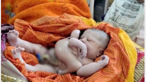 인도서 팔·다리 4개인 아기 출산…“신의 화신이 태어났다”