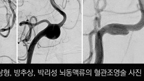 4060女생명 위협하는 ‘뇌동맥류’ 건강검진으로 예방