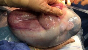 스페인서 8만분의1 확률로 태어난 쌍둥이