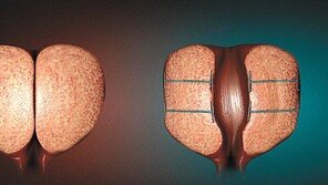 골칫거리 전립샘비대증… 부작용 적은 유로리프트로 안전하게 개선