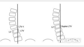 “요추 고정 최소화 청소년 척추측만증 진단법 개발”