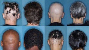 이 약 먹었더니, 원형 탈모증 3명 중 1명 ‘풍성’…기대감↑