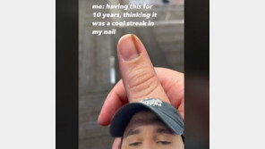 손톱에 있는 갈색 줄, ‘암’이었다