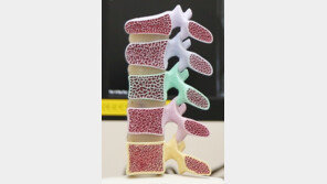 “4cm 이상 키 줄었다면 골다공증 의심…‘걷기 운동’으로 예방해야”