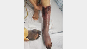 “결혼 약속 30세 여친, 백신 접종 뒤 다리 괴사해 절단” 남친 울분