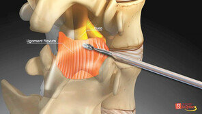 “척추는 거미줄처럼 복잡한 구조… 추간공확장술 후 치료 기간-예후 달라”