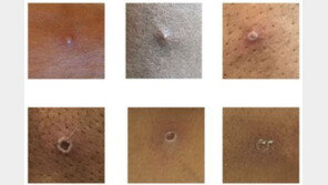 WHO, 원숭이두창 개명 논의 착수…“낙인·차별 우려”