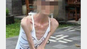 “날씬해지고 싶다” 165㎝에 25㎏ 거식증 여성, 병원치료 거부