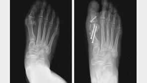 “뼈-발바닥 통증으로 큰 불편… 걷고난 후 발 스트레칭하세요”