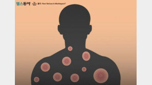 수두 아닌 원숭이두창일 가능성 높은 세 가지 증상