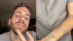 “여드름인 줄”…원숭이두창 감염 美배우 경험담 