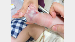 생후 72일 아기 손등 괴사…“링거 테이핑 떼자 살점 뜯겼다”